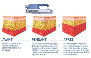 Principe de fonctionnement de l'Emsculpt